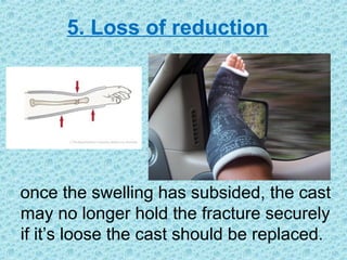 5. Loss of reduction
once the swelling has subsided, the cast
may no longer hold the fracture securely
if it’s loose the cast should be replaced.
 