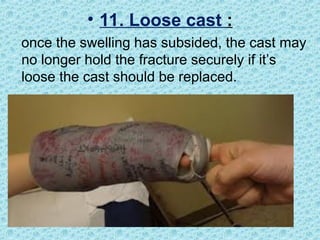 • 11. Loose cast :
once the swelling has subsided, the cast may
no longer hold the fracture securely if it’s
loose the cast should be replaced.
 