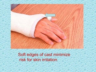 Soft edges of cast minimize
risk for skin irritation.
 