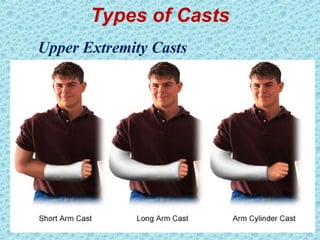 Types of Casts
Upper Extremity Casts
 