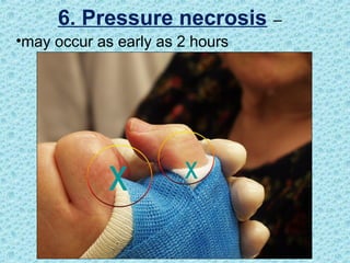 x x
6. Pressure necrosis –
•may occur as early as 2 hours
 