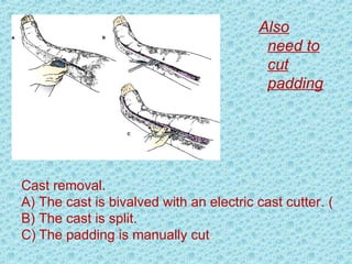 Cast removal.
A) The cast is bivalved with an electric cast cutter. (
B) The cast is split.
C) The padding is manually cut.
Also
need to
cut
padding
 