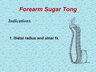 Forearm Sugar Tong
1. Distal radius and ulnar fx.
Indications
 