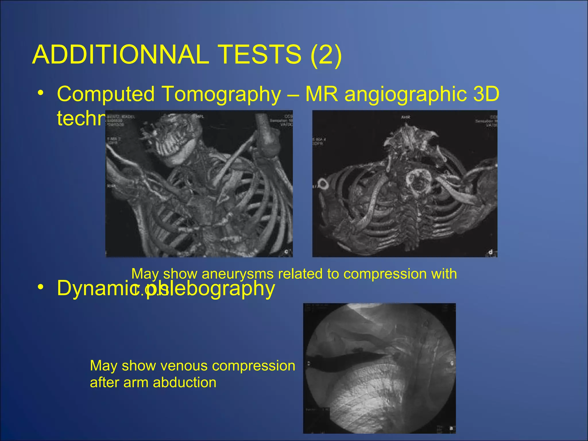 ADDITIONNAL TESTS (2) Computed Tomography – MR angiographic 3D technique Dynamic phlebography May show venous compression after arm abduction May show aneurysms related to compression with T.O.S. 