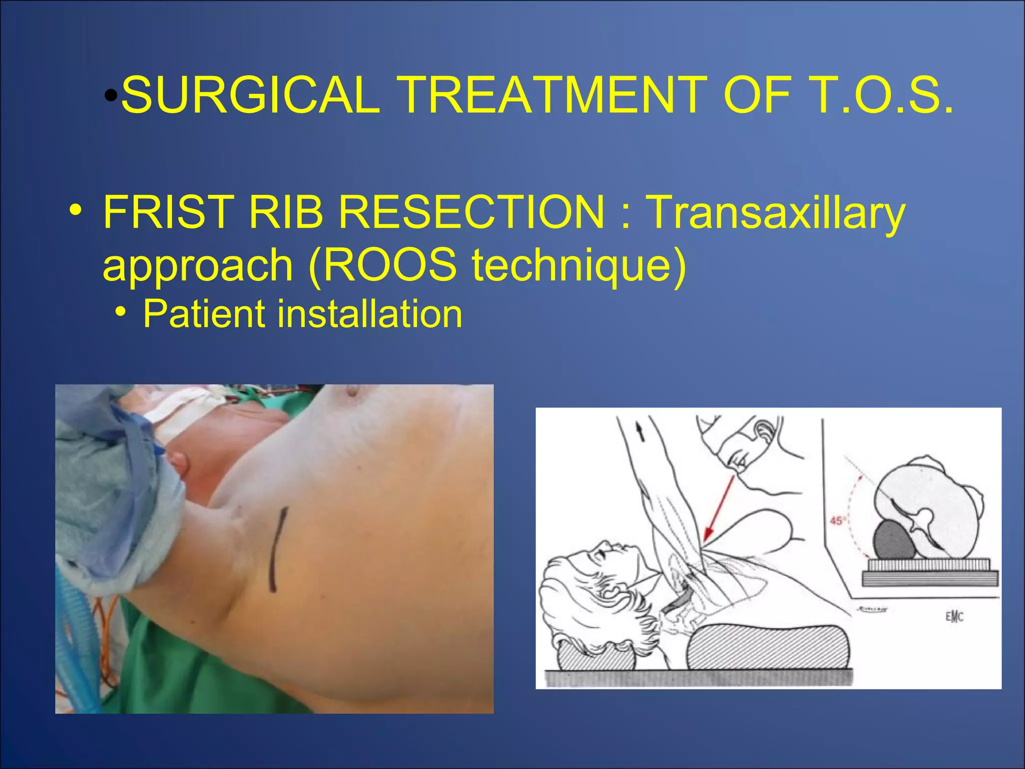 SURGICAL TREATMENT OF T.O.S. FRIST RIB RESECTION : Transaxillary approach (ROOS technique) Patient installation 