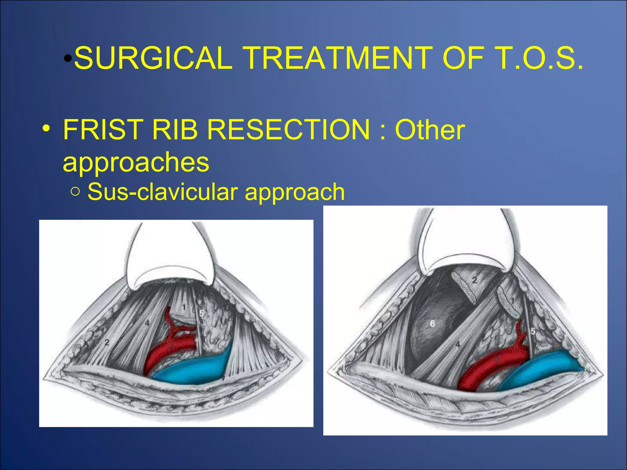SURGICAL TREATMENT OF T.O.S. FRIST RIB RESECTION : Other approaches Sus-clavicular approach 