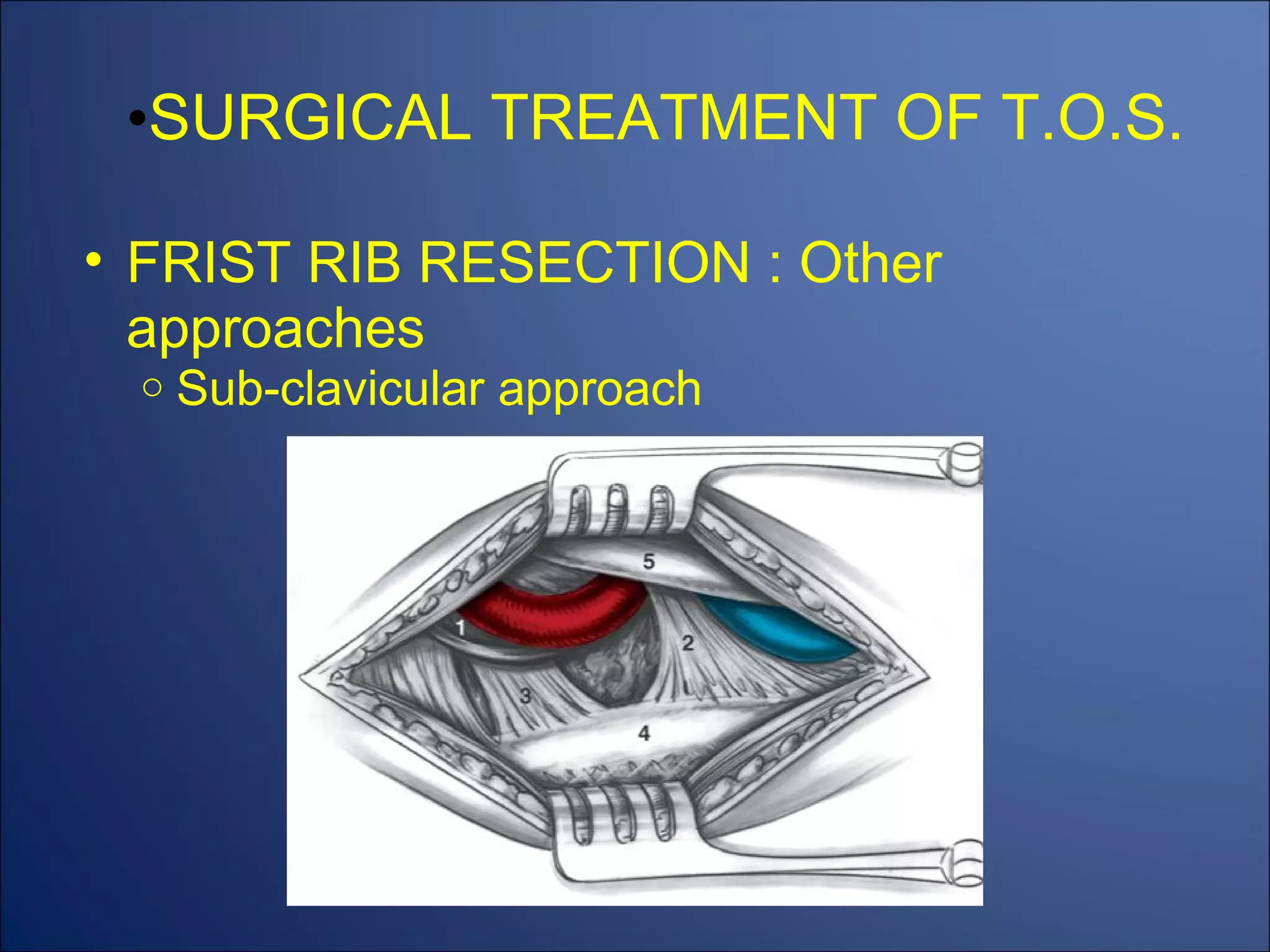 SURGICAL TREATMENT OF T.O.S. FRIST RIB RESECTION : Other approaches Sub-clavicular approach 