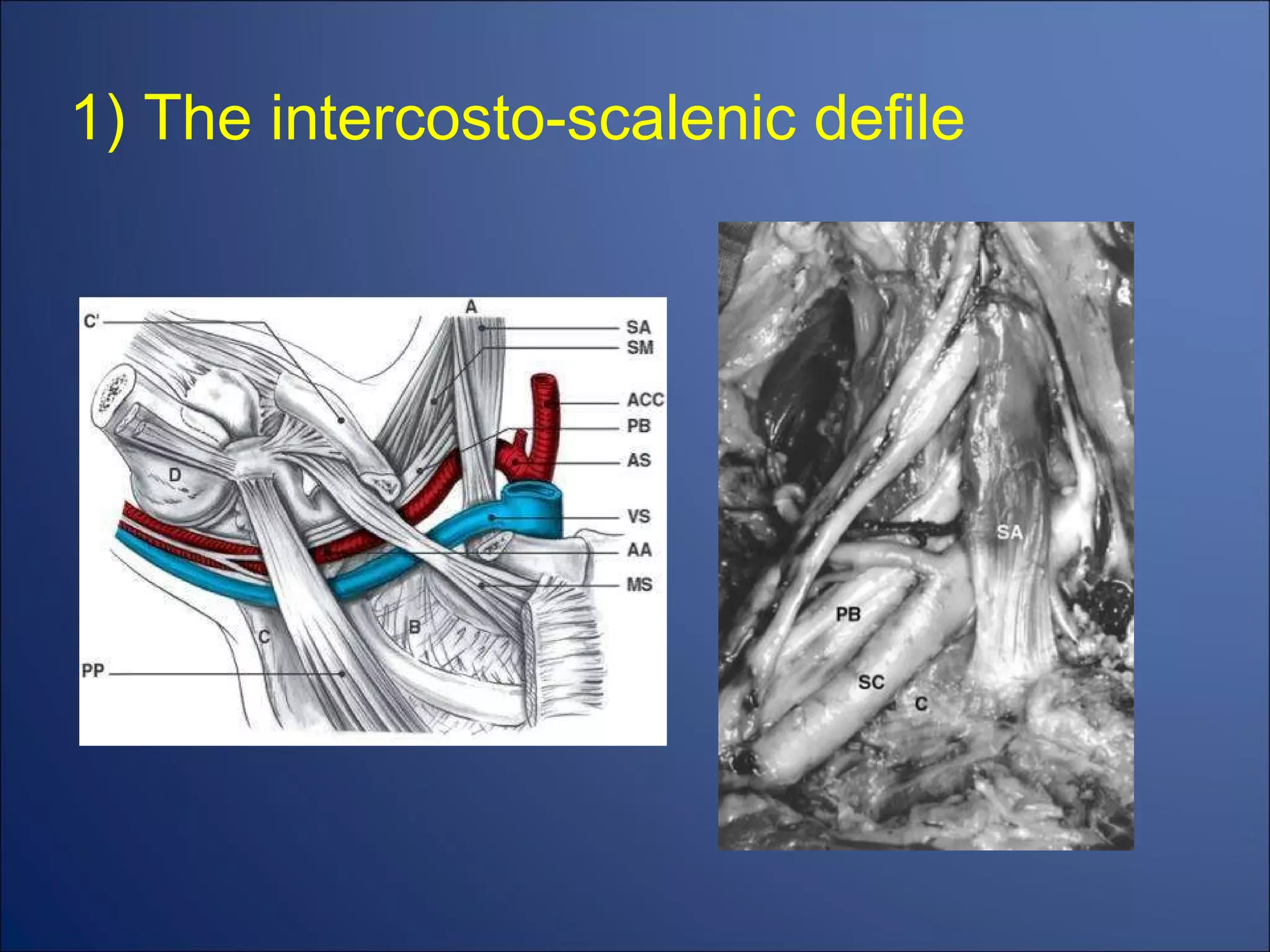 1) The intercosto-scalenic defile 