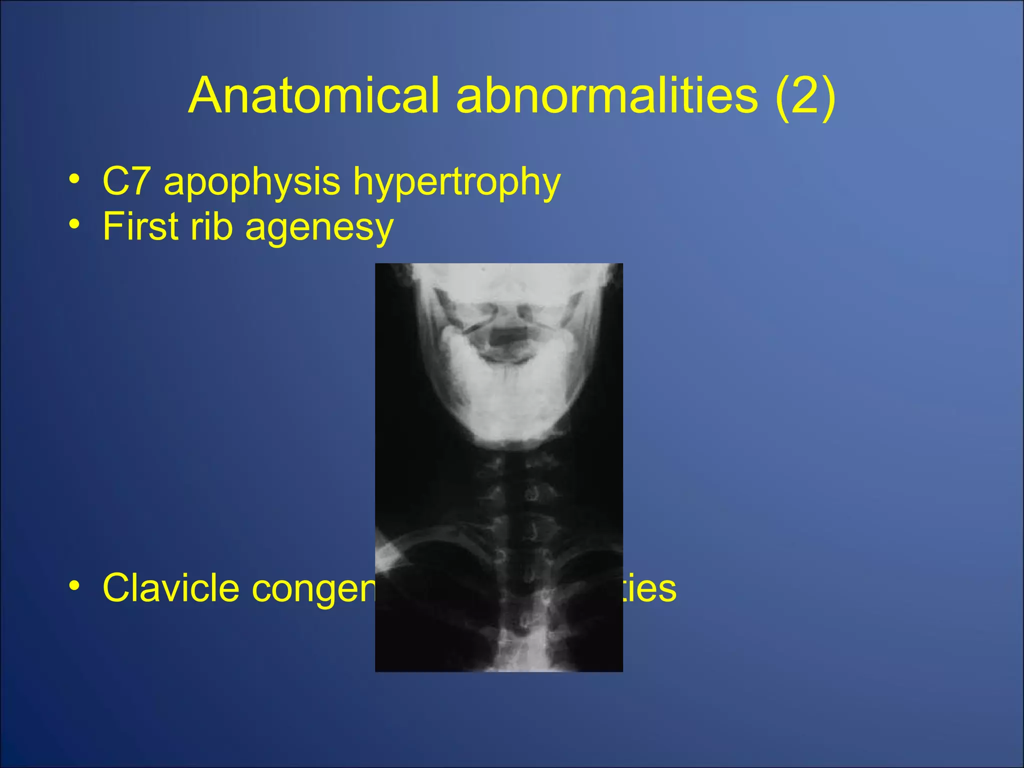 Anatomical abnormalities (2) C7 apophysis hypertrophy First rib agenesy Clavicle congenital abnormalities 