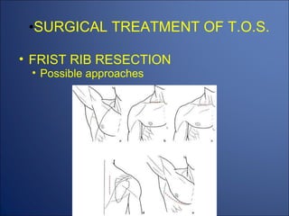 THORACIC OUTLET SYNDROM (TOS) | PPT
