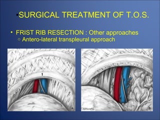 THORACIC OUTLET SYNDROM (TOS) | PPT