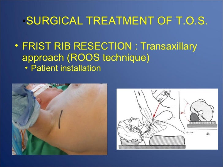 Thoracic outlet complications