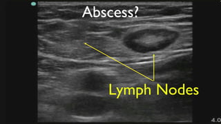 Pocus Lymph Node Normal Elkhunovich_POCUS-PPT-wide-3 using for diagnosis | PDF