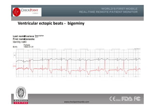 Ventricular ectopic beats - bigeminy
www.checkpointcardio.com
 