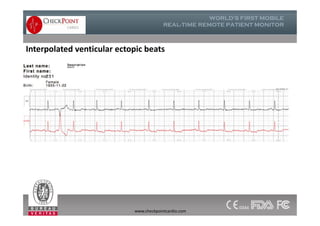 Interpolated venticular ectopic beats
www.checkpointcardio.com
 