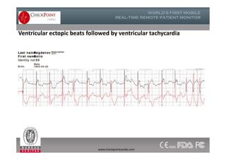 Ventricular ectopic beats followed by ventricular tachycardia
www.checkpointcardio.com
 