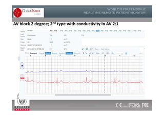 AV block 2 degree; 2nd type with conductivity in AV 2:1
www.checkpointcardio.com
 