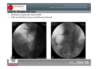• Admitted at hospital with inferior STEMI
• SCAG revealed RCA occlusion and pPCI was performed
Case 6: 72-year-old man
 