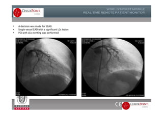 • A decision was made for SCAG
• Single-vessel CAD with a significant LCx lesion
• PCI with LCx stenting was performed
 