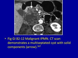 82 cystic pancreatic masses on ct and mri | PPTX
