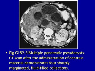 82 cystic pancreatic masses on ct and mri | PPTX