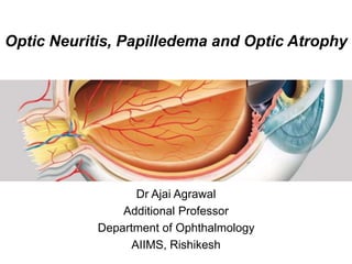 Optic Neuritis, Papilledema and Optic Atrophy
Dr Ajai Agrawal
Additional Professor
Department of Ophthalmology
AIIMS, Rishikesh
 