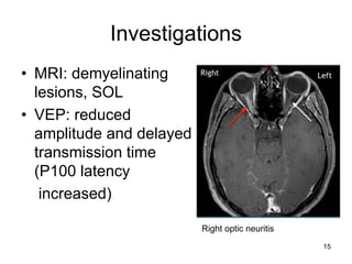 Investigations
• MRI: demyelinating
lesions, SOL
• VEP: reduced
amplitude and delayed
transmission time
(P100 latency
increased)
Right optic neuritis
15
 