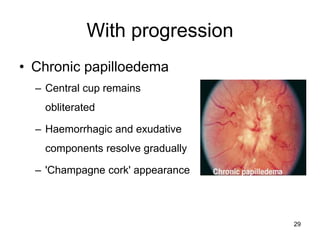 With progression
• Chronic papilloedema
– Central cup remains
obliterated
– Haemorrhagic and exudative
components resolve gradually
– 'Champagne cork' appearance
29
 