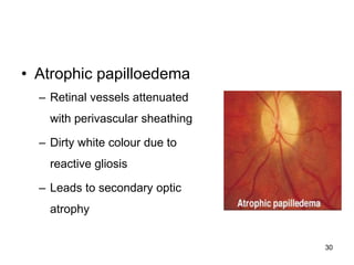 • Atrophic papilloedema
– Retinal vessels attenuated
with perivascular sheathing
– Dirty white colour due to
reactive gliosis
– Leads to secondary optic
atrophy
30
 