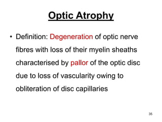 Optic Atrophy
• Definition: Degeneration of optic nerve
fibres with loss of their myelin sheaths
characterised by pallor of the optic disc
due to loss of vascularity owing to
obliteration of disc capillaries
35
 