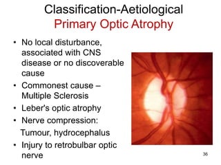 Classification-Aetiological
Primary Optic Atrophy
• No local disturbance,
associated with CNS
disease or no discoverable
cause
• Commonest cause –
Multiple Sclerosis
• Leber's optic atrophy
• Nerve compression:
Tumour, hydrocephalus
• Injury to retrobulbar optic
nerve 36
 