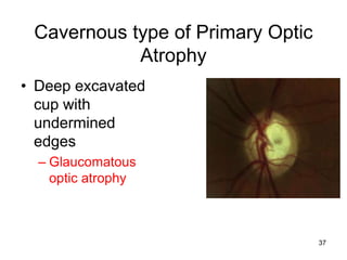 Cavernous type of Primary Optic
Atrophy
• Deep excavated
cup with
undermined
edges
– Glaucomatous
optic atrophy
37
 