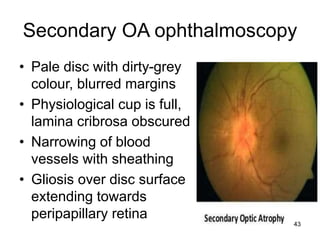 Secondary OA ophthalmoscopy
• Pale disc with dirty-grey
colour, blurred margins
• Physiological cup is full,
lamina cribrosa obscured
• Narrowing of blood
vessels with sheathing
• Gliosis over disc surface
extending towards
peripapillary retina
43
 