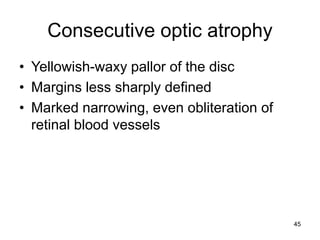Consecutive optic atrophy
• Yellowish-waxy pallor of the disc
• Margins less sharply defined
• Marked narrowing, even obliteration of
retinal blood vessels
45
 