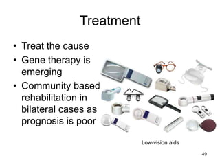 Treatment
• Treat the cause
• Gene therapy is
emerging
• Community based
rehabilitation in
bilateral cases as
prognosis is poor
Low-vision aids
49
 