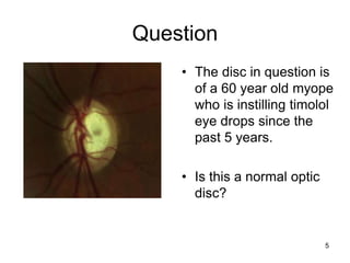 Question
• The disc in question is
of a 60 year old myope
who is instilling timolol
eye drops since the
past 5 years.
• Is this a normal optic
disc?
5
 