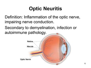 Optic Neuritis
Definition: Inflammation of the optic nerve,
impairing nerve conduction.
Secondary to demyelination, infection or
autoimmune pathology.
6
 