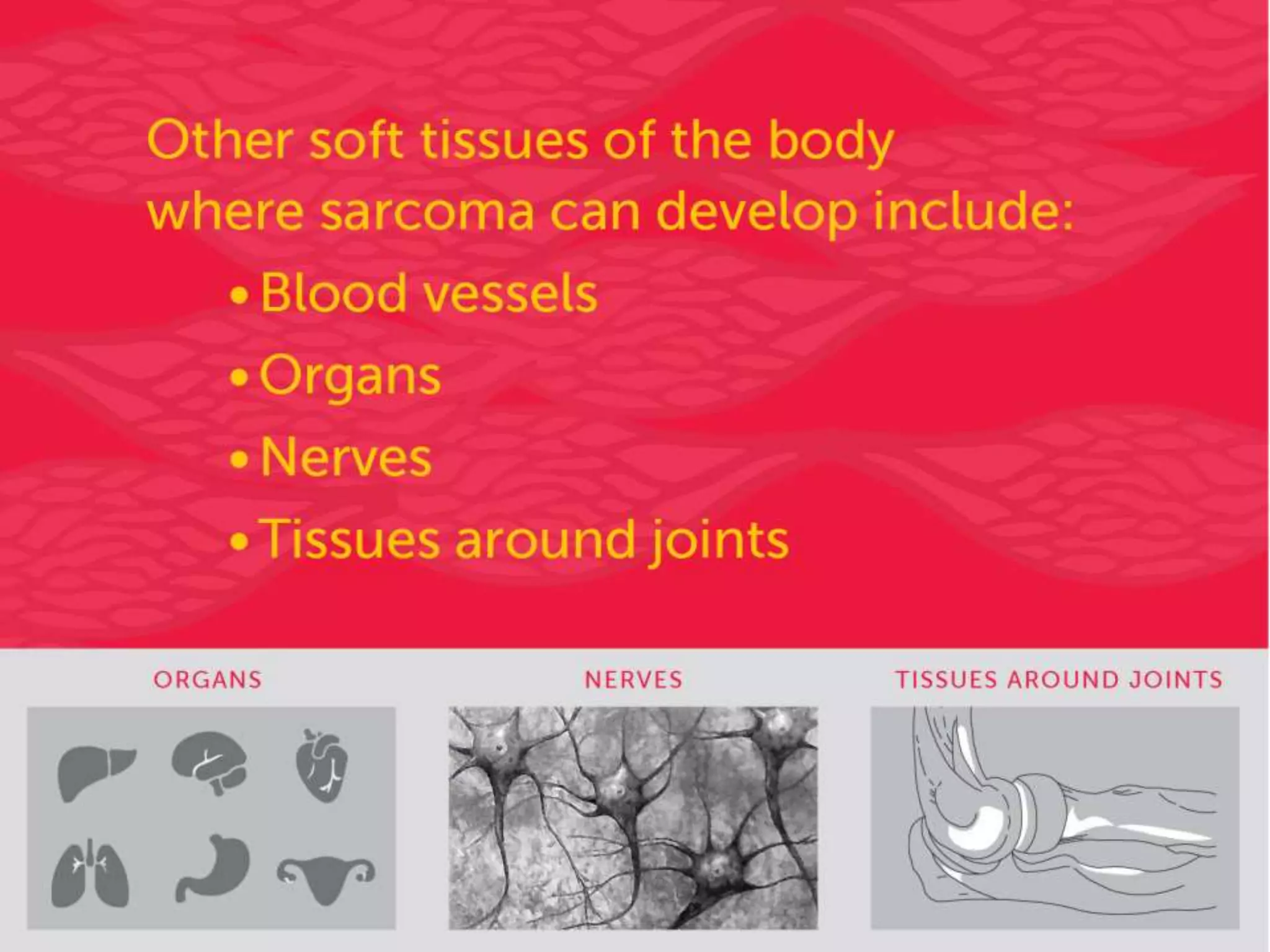 Soft Tissue Sarcomas: Symptoms and Risk Factors