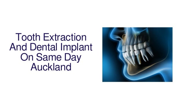 Tooth Extraction
And Dental Implant
On Same Day
Auckland
 