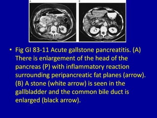 83 solid pancreatic masses on computed tomography Slide 13