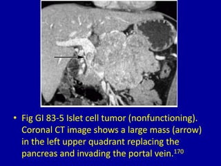 83 solid pancreatic masses on computed tomography Slide 7