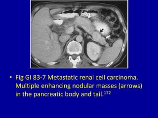 83 solid pancreatic masses on computed tomography Slide 9