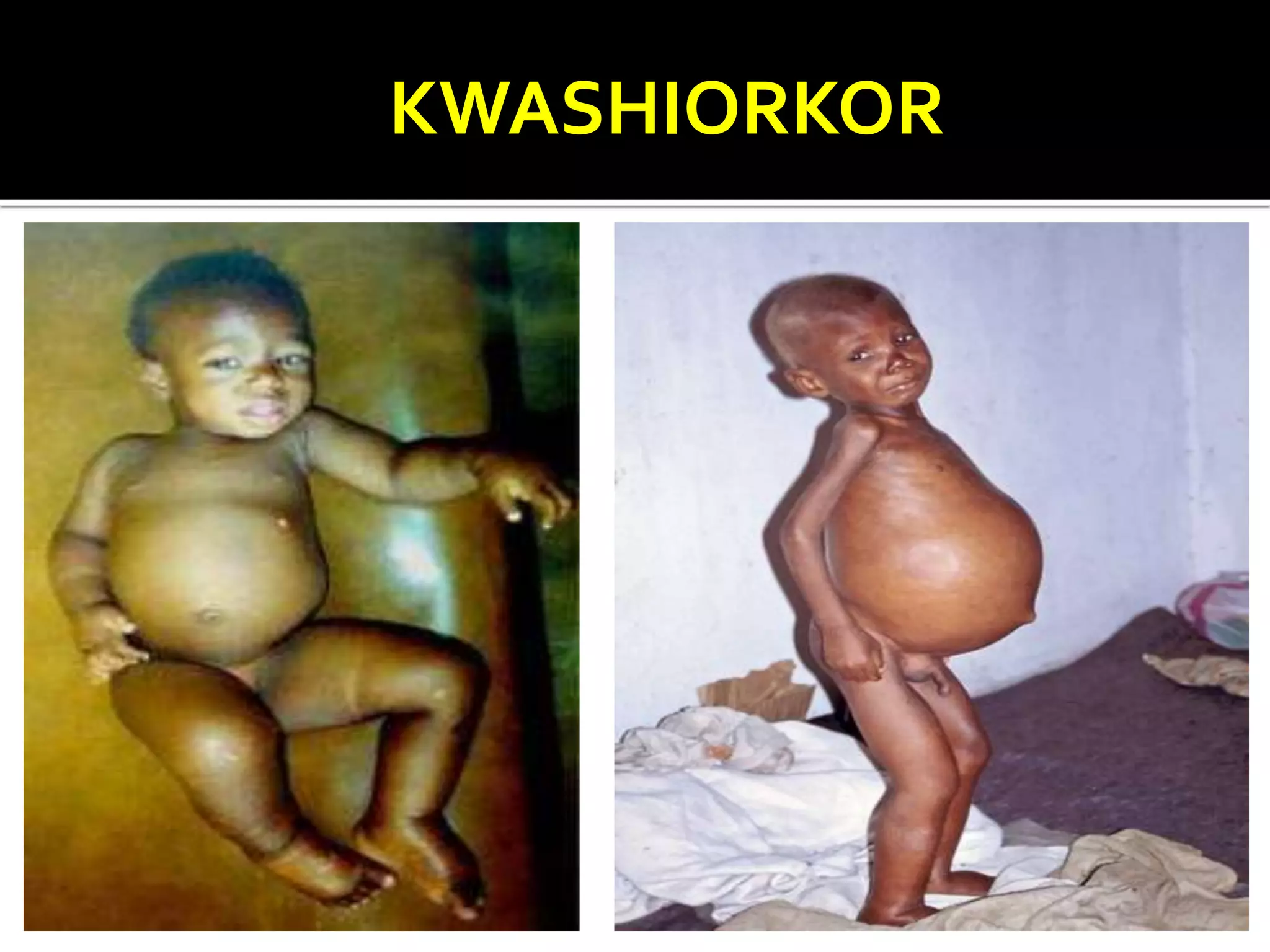 KWASHIORKOR
 
