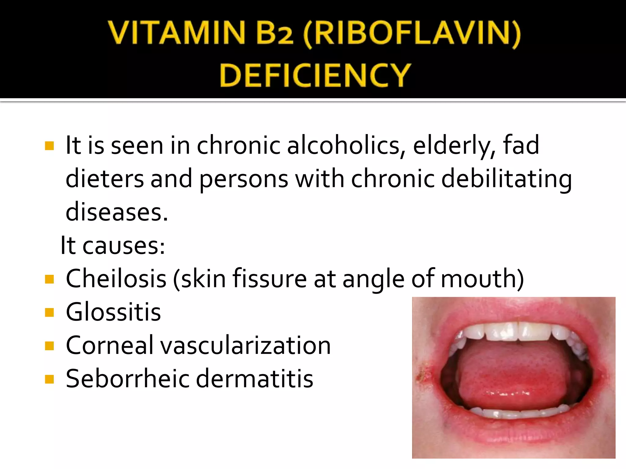  It is seen in chronic alcoholics, elderly, fad
dieters and persons with chronic debilitating
diseases.
It causes:
 Cheilosis (skin fissure at angle of mouth)
 Glossitis
 Corneal vascularization
 Seborrheic dermatitis
 