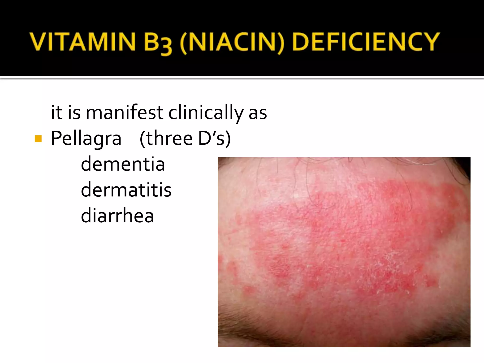 it is manifest clinically as
 Pellagra (three D’s)
dementia
dermatitis
diarrhea
 