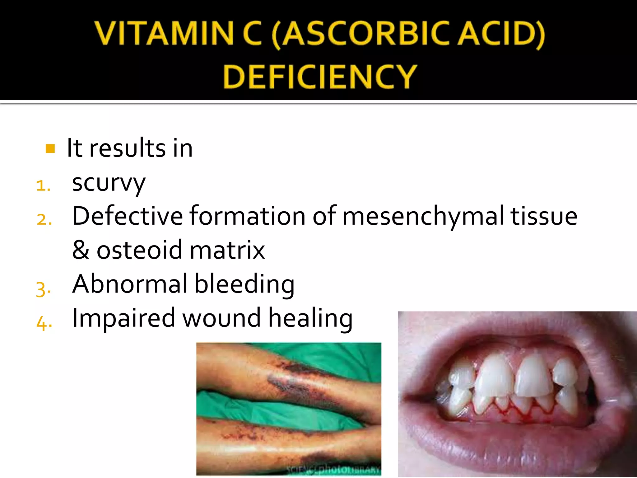  It results in
1. scurvy
2. Defective formation of mesenchymal tissue
& osteoid matrix
3. Abnormal bleeding
4. Impaired wound healing
 