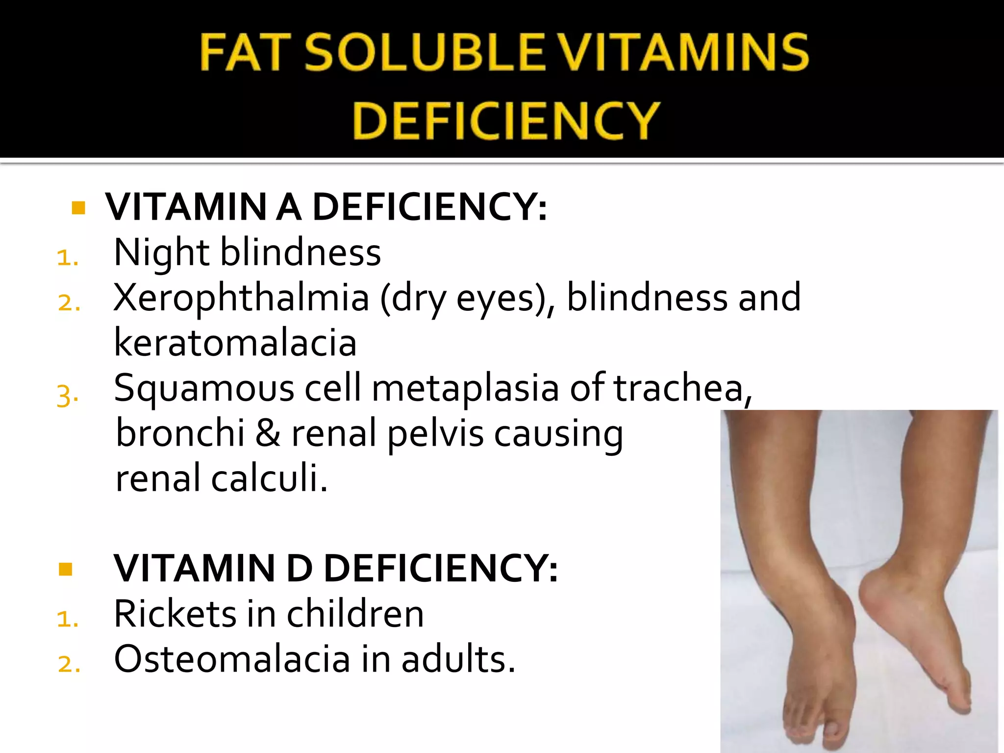  VITAMIN A DEFICIENCY:
1. Night blindness
2. Xerophthalmia (dry eyes), blindness and
keratomalacia
3. Squamous cell metaplasia of trachea,
bronchi & renal pelvis causing
renal calculi.
 VITAMIN D DEFICIENCY:
1. Rickets in children
2. Osteomalacia in adults.
 
