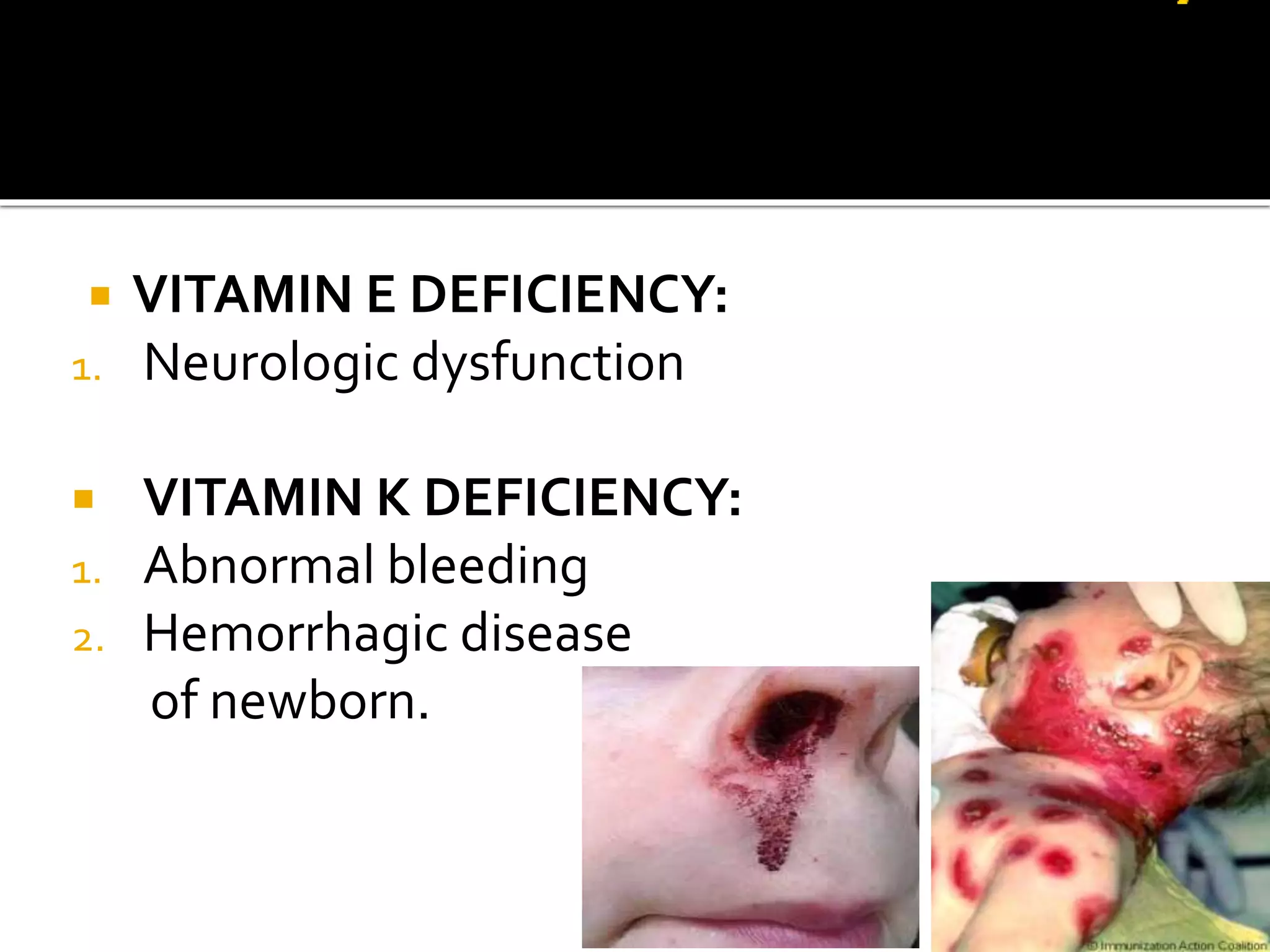  VITAMIN E DEFICIENCY:
1. Neurologic dysfunction
 VITAMIN K DEFICIENCY:
1. Abnormal bleeding
2. Hemorrhagic disease
of newborn.
 