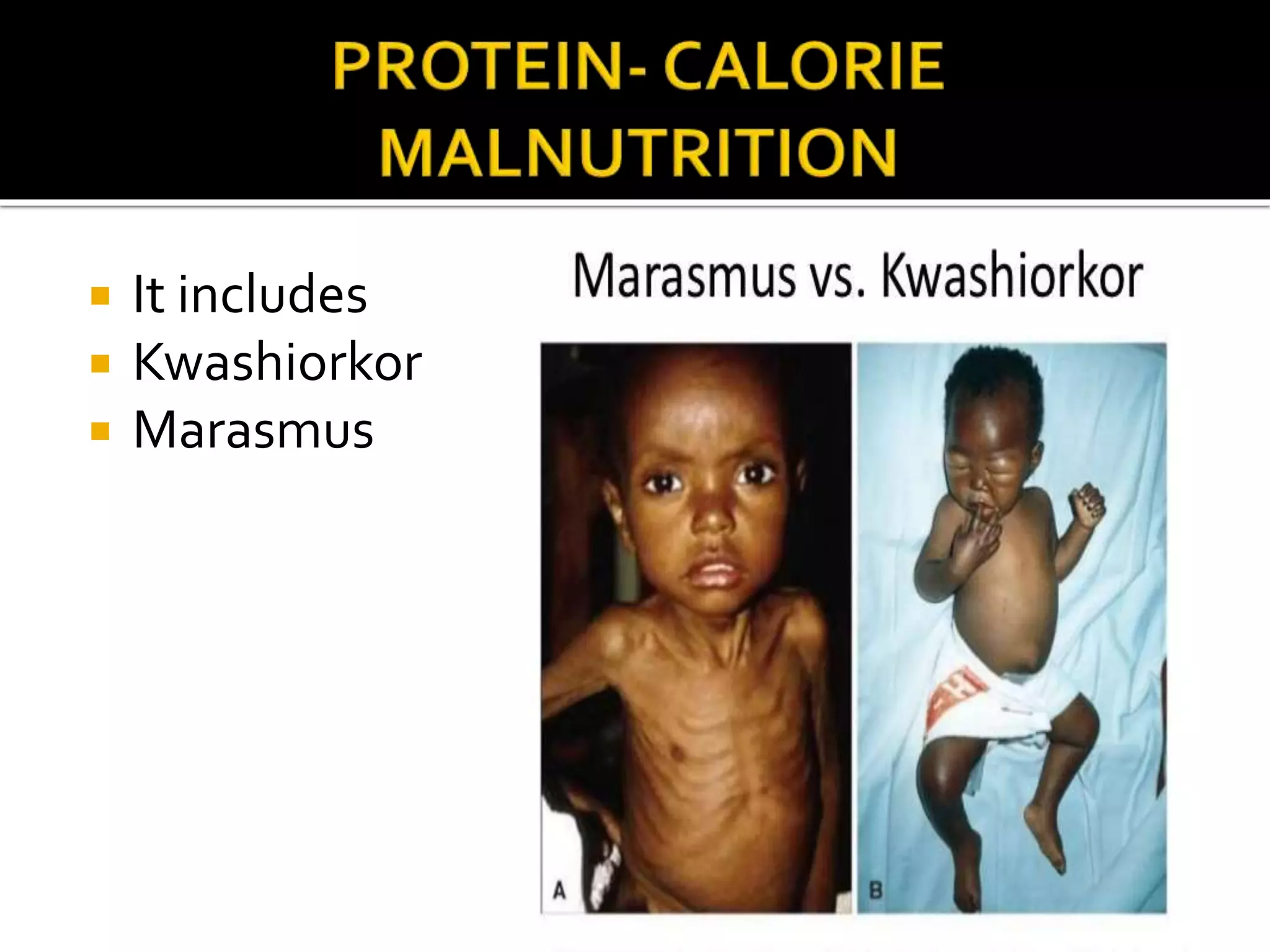  It includes
 Kwashiorkor
 Marasmus
 
