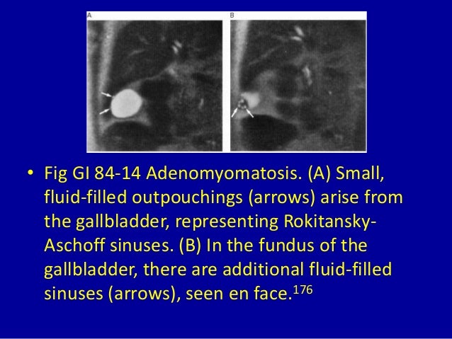 84 magnetic resonance cholangiography